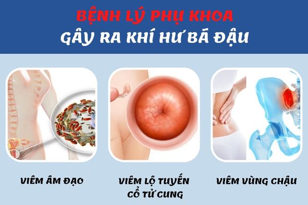 Có nhiều bệnh lý phụ khoa gây ra khí hư bã đậu