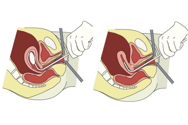 Hút thai là phương pháp đình chỉ thai an toàn được sử dụng phổ biến