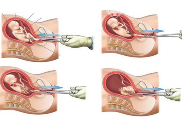 Nong gắp thai được áp dụng cho thai nhi có tuổi thai lớn