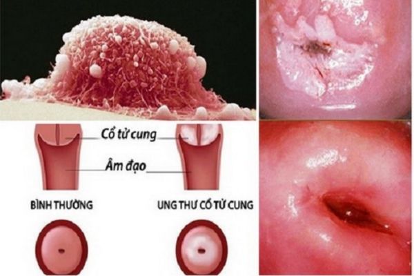 Ung thư cổ tử cung là bệnh lý nguy hiểm ở nữ giới