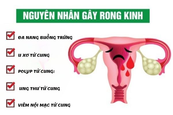 Nguyên nhân gây bệnh rong kinh ở nữ giới