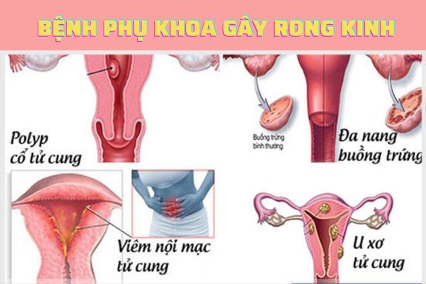 Rong kinh có thể do các bệnh lý phụ khoa gây nên