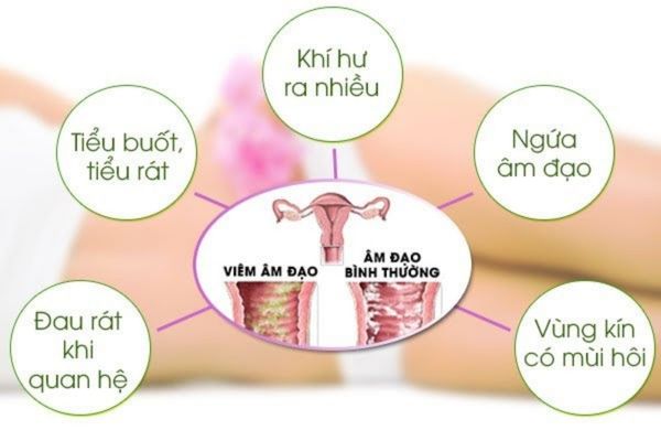 Viêm âm đạo gây ra tình trạng ngứa rát vùng kín phổ biến ở các chị em