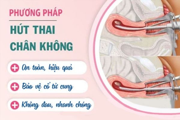 Phương pháp hút thai chân không được áp dụng cho thai 3 tháng tuổi