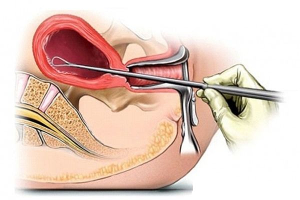 Nạo thai là phương pháp áp dụng cho mẹ bầu có tuổi thai lớn