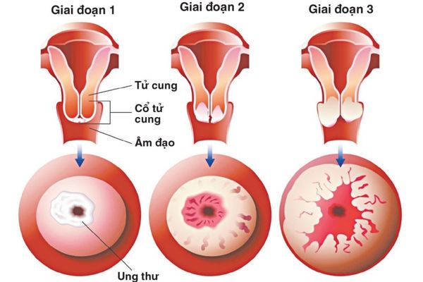 Quan hệ bị ra máu do ung thư âm đạo