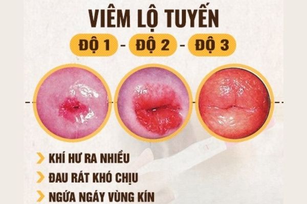 Viêm lộ tuyến tử cung là bệnh lý khá phổ biến ở nữ giới