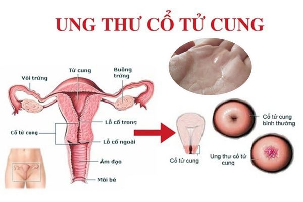 Ung thư tử cung ảnh hưởng đến sức khỏe sinh sản của nữ giới