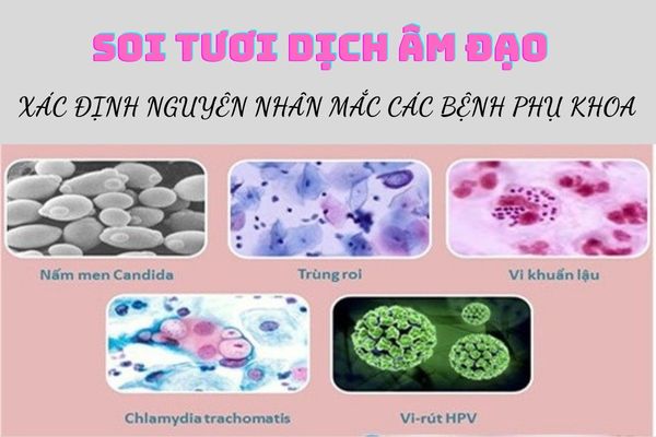 Soi dịch tươi âm đạo để tìm ra các nguyên nhân bệnh lý