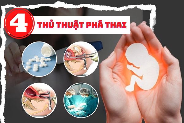 Top 4 thủ thuật phá thai an toàn được ứng dụng phổ biến