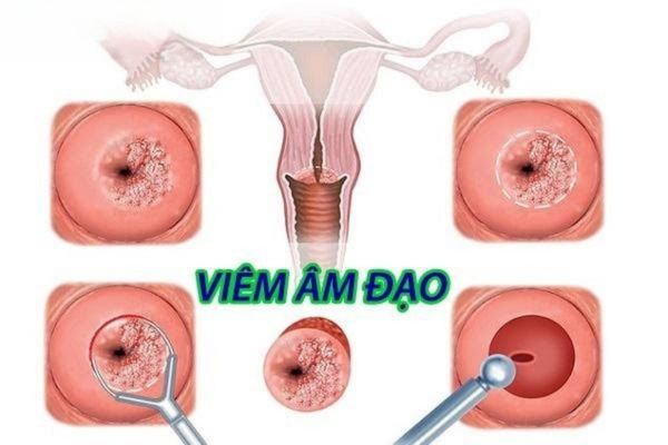 Vùng kín khô, đau rát do bị viêm âm đạo