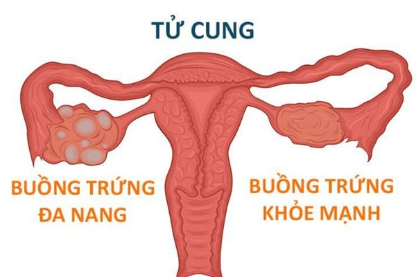 Đa nang buồng trứng làm vùng kín bị khô rát, khó chịu