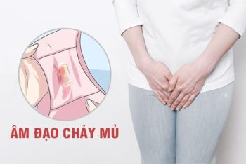 Âm đạo chảy mủ là biểu hiện của bệnh gì? Có nguy hiểm không?