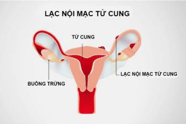 Âm đạo ra máu màu nâu cảnh báo bệnh lạc nội mạc tử cung