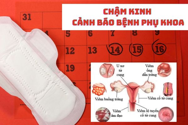 Chậm kinh cảnh báo nhiều bệnh lý phụ khoa nguy hiểm