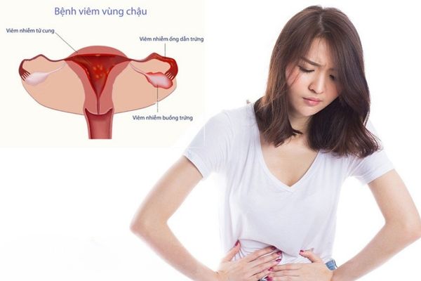 Viêm vùng chậu gây ra tình trạng đau bụng buồn nôn