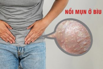 Cảnh báo bệnh nguy hiểm gây nổi mụn ở bìu