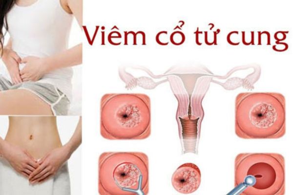 Quan hệ chảy máu do viêm cổ tử cung gây nên