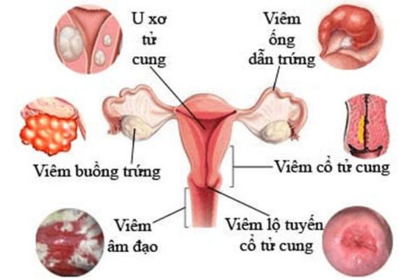 Các bệnh lý phụ khoa gây trễ kinh 3 tháng liên tiếp