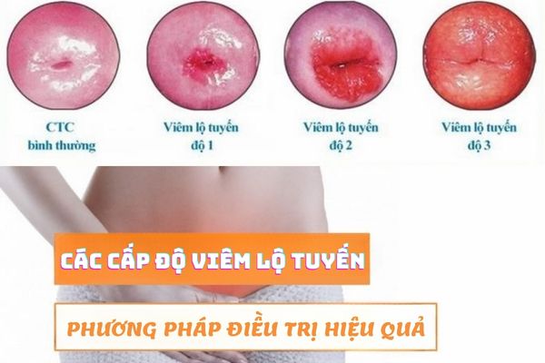 Các cấp độ viêm lộ tuyến và phương pháp điều trị an toàn