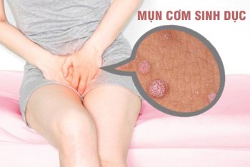 Địa chỉ điều trị mụn cơm sinh dục uy tín, chất lượng
