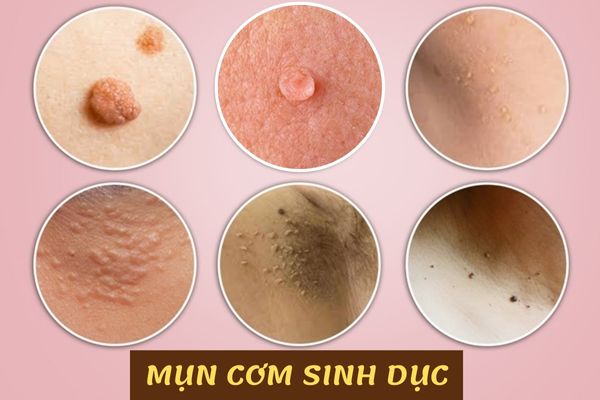 Mun-com-sinh-duc-1