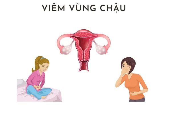 Tổng hợp thông tin cần biết về bệnh viêm vùng chậu