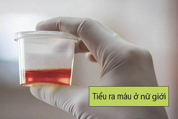 Tiểu ra máu ở nữ có biến chứng như thế nào? Làm sao để khắc phục?
