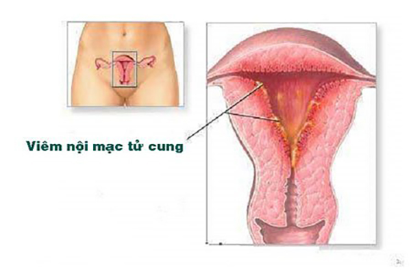 Viem-noi-mac-tu-cung