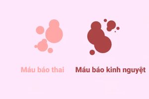 Phân biệt máu báo thai và máu kinh nguyệt