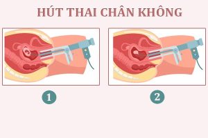 Tổng hợp các phương pháp phá thai an toàn theo tháng tuổi 