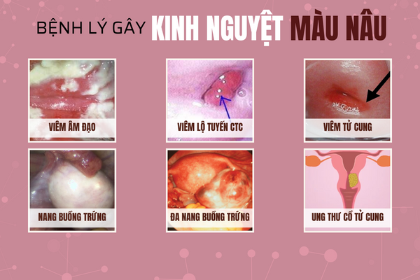 Vi-sao-xay-ra-tinh-trang-kinh-nguyet-mau-nau-2