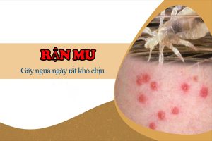 Rận mu – Những thông tin quan trọng bạn cần biết