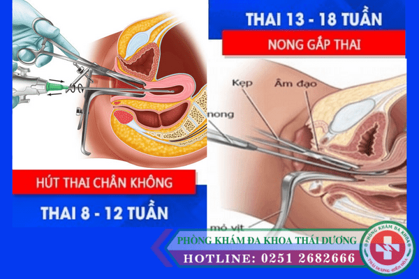 ba-phuong-phap-pha-thai-khong-dau-hien-nay-2