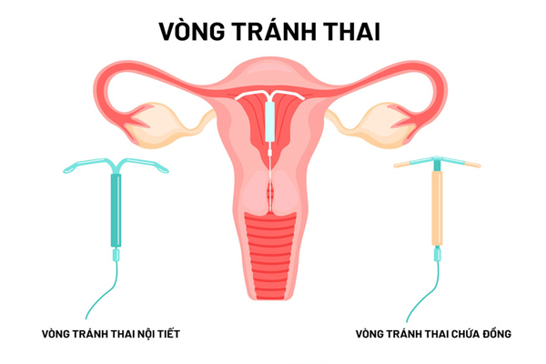 Hai loại vòng tránh thai được áp dụng phổ biến hiện nay