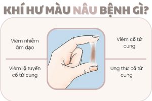 Khí hư màu nâu bệnh gì – Điều trị sớm tránh biến chứng xấu