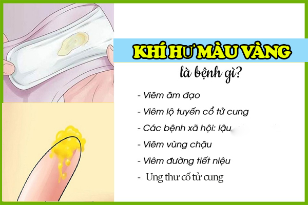 Khí hư màu vàng biểu hiện bệnh lý cần khám sớm