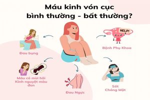 Kinh nguyệt vón cục – Bình thường hay bất thường