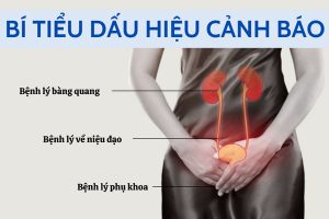 Nguyên nhân gây bí tiểu đáng lo ngại.