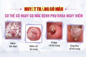 Huyết trắng có máu – Bệnh lý nguy hiểm tiềm tàng