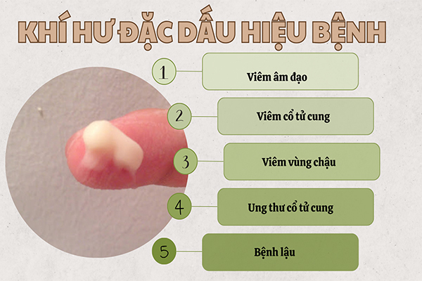 Khí hư đặc dấu hiệu cảnh báo bệnh lý phụ khoa