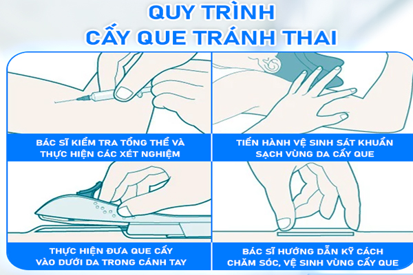 Quy trình cấy que tránh thai khoa học tại Phòng Khám Trường Hải