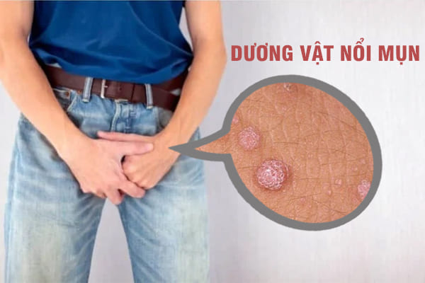 Nổi mụn ở dương vật là bị gì?