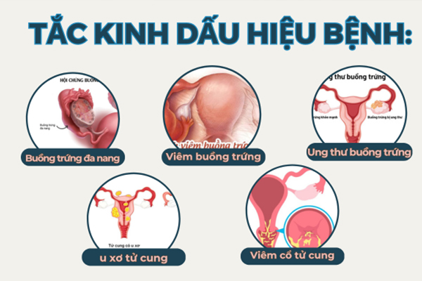 Tắc kinh nguyệt - Cảnh báo điều gì ở sức khỏe nữ giới