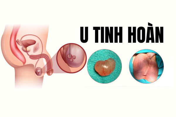 u-tinh-hoan-la-benh-gi-dieu-tri-nhu-the-nao-1