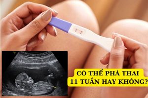 Tìm hiểu phương pháp và chi phí phá thai 11 tuần tuổi