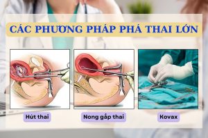 Thai lớn phá được không? Phương pháp thực hiện như thế nào?