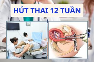 Phương pháp hút thai 12 tuần là gì? Địa chỉ phá thai an toàn tại Hải Dương