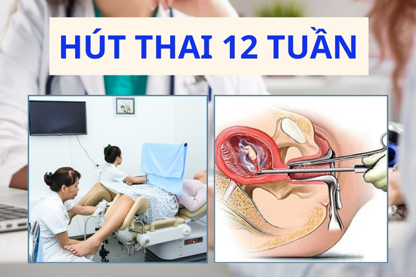 Hút thai 12 tuần