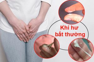 Khí hư ra dịch trắng sữa – Có phải dấu hiệu bệnh lý hay không?